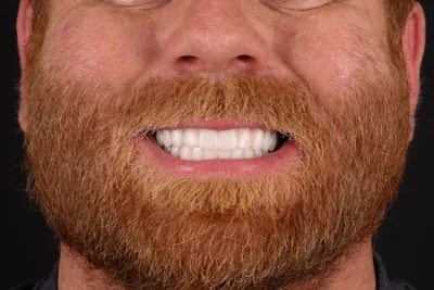Patient smile after dental implants