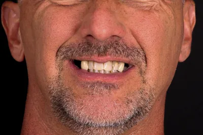 Patient smile after dental implants