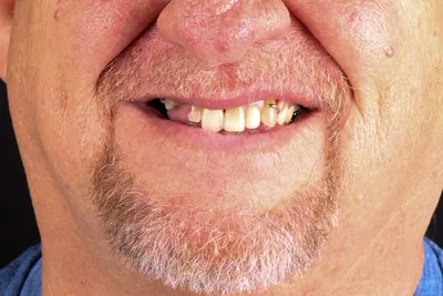 Patient smile after dental implants