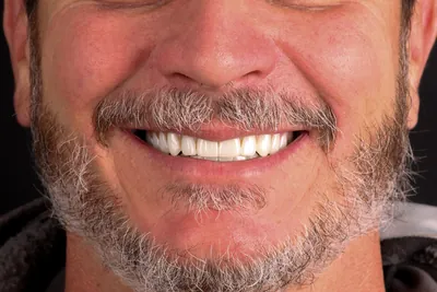 Patient smile after dental implants