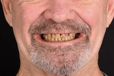 Patient smile after dental implants