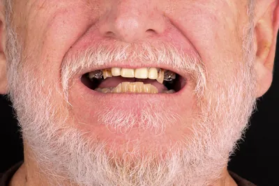 Patient smile after dental implants