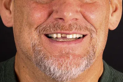 Patient smile after dental implants