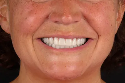 Patient smile after dental implants