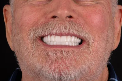 Patient smile after dental implants