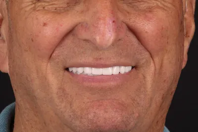 Patient smile after dental implants