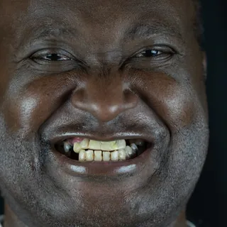 The same patient before treatment, with worn and broken teeth