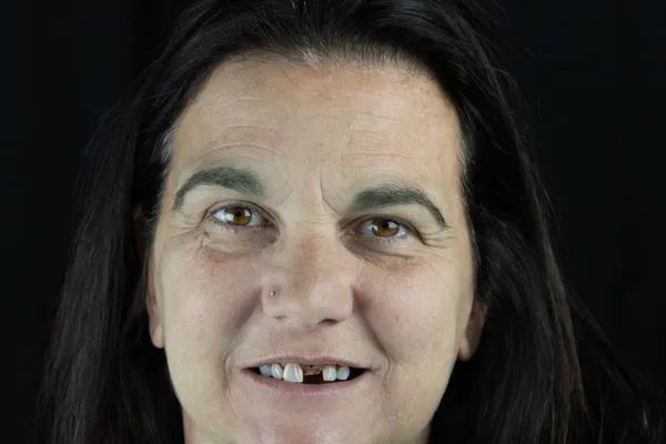 The same patient before All-on-4 treatment